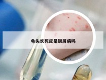 龟头长死皮是银屑病吗