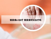银屑病o3水疗 银屑病可以水疗吗