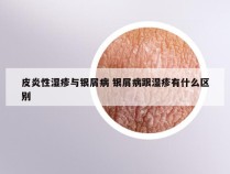 皮炎性湿疹与银屑病 银屑病跟湿疹有什么区别