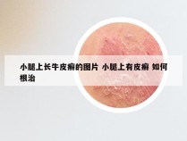 小腿上长牛皮癣的图片 小腿上有皮癣 如何根治