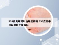 999皮炎平可以治牛皮癣嘛 999皮炎平可以治疗牛皮癣吗