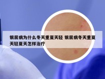 银屑病为什么冬天重夏天轻 银屑病冬天重夏天轻夏天怎样治疗