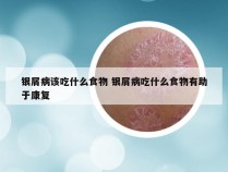 银屑病该吃什么食物 银屑病吃什么食物有助于康复