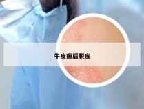 牛皮癣后脱皮