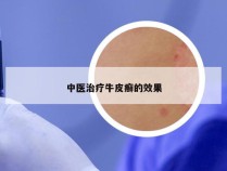 中医治疗牛皮癣的效果