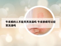 牛皮癣的人不能天天洗澡吗 牛皮肤癣可以经常洗澡吗