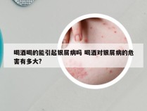 喝酒喝的能引起银屑病吗 喝酒对银屑病的危害有多大?
