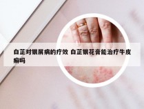 白芷对银屑病的疗效 白芷银花膏能治疗牛皮癣吗