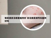 银屑病青岛哪里医院好 青岛银屑病专科医院好吗