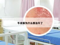 牛皮癣为什么根治不了