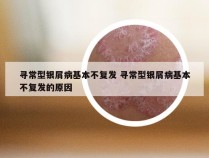 寻常型银屑病基本不复发 寻常型银屑病基本不复发的原因