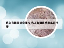 头上有银屑病会图片 头上有银屑病怎么治疗好