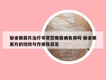 郁金银屑片治疗寻常型银屑病有用吗 郁金银屑片的功效与作用及禁忌