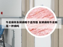 牛皮癣和鱼鳞病哪个遗传强 鱼鳞病和牛皮癣是一种病吗