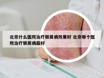 北京什么医院治疗银屑病效果好 北京哪个医院治疗银屑病最好