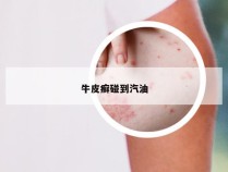 牛皮癣碰到汽油