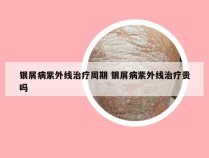银屑病紫外线治疗周期 银屑病紫外线治疗贵吗