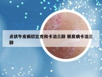 点状牛皮癣欣比克和卡泊三醇 银屑病卡泊三醇