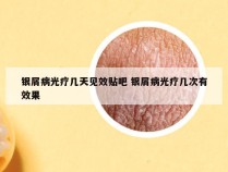 银屑病光疗几天见效贴吧 银屑病光疗几次有效果
