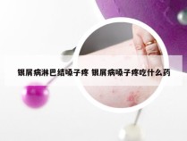 银屑病淋巴结嗓子疼 银屑病嗓子疼吃什么药