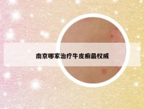 南京哪家治疗牛皮癣最权威