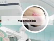 牛皮癣专家哪里好