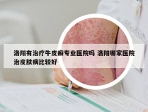 洛阳有治疗牛皮癣专业医院吗 洛阳哪家医院治皮肤病比较好