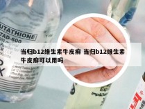 当归b12维生素牛皮癣 当归b12维生素牛皮癣可以用吗