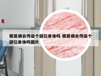 银屑病会传染个部位身体吗 银屑病会传染个部位身体吗图片