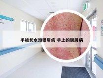 手被长水泡银屑病 手上的银屑病
