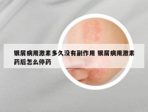 银屑病用激素多久没有副作用 银屑病用激素药后怎么停药
