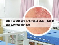 手指上有银屑病怎么治疗最好 手指上有银屑病怎么治疗最好的方法