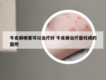 牛皮癣哪里可以治疗好 牛皮癣治疗最权威的医院