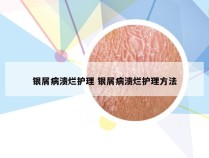 银屑病溃烂护理 银屑病溃烂护理方法