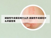 顽固性牛皮癣该用什么药 顽固性牛皮癣吃什么药最管用