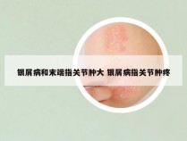 银屑病和末端指关节肿大 银屑病指关节肿疼
