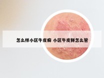 怎么样小区牛皮癣 小区牛皮鲜怎么管
