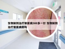 生物制剂治疗银屑病300多一针 生物制剂治疗银屑病贵吗