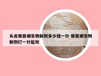 头皮银屑病生物制剂多少钱一针 银屑病生物制剂打一针起效