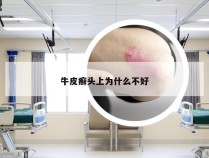 牛皮癣头上为什么不好