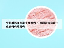 中药威灵仙能治牛皮癣吗 中药威灵仙能治牛皮癣吗有效果吗