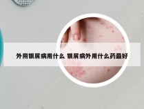 外阴银屑病用什么 银屑病外用什么药最好