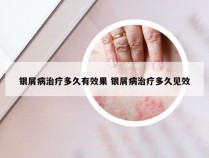 银屑病治疗多久有效果 银屑病治疗多久见效