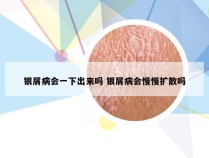 银屑病会一下出来吗 银屑病会慢慢扩散吗