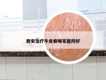 西安治疗牛皮癣哪家医院好