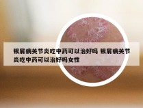 银屑病关节炎吃中药可以治好吗 银屑病关节炎吃中药可以治好吗女性