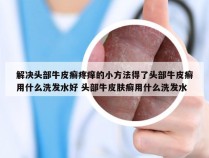 解决头部牛皮癣疼痒的小方法得了头部牛皮癣用什么洗发水好 头部牛皮肤癣用什么洗发水