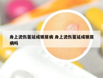 身上烫伤蔓延成银屑病 身上烫伤蔓延成银屑病吗