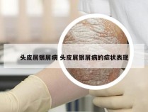 头皮屑银屑病 头皮屑银屑病的症状表现
