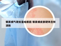 银屑病气硬皮是啥原因 银屑病皮肤硬块怎样消除